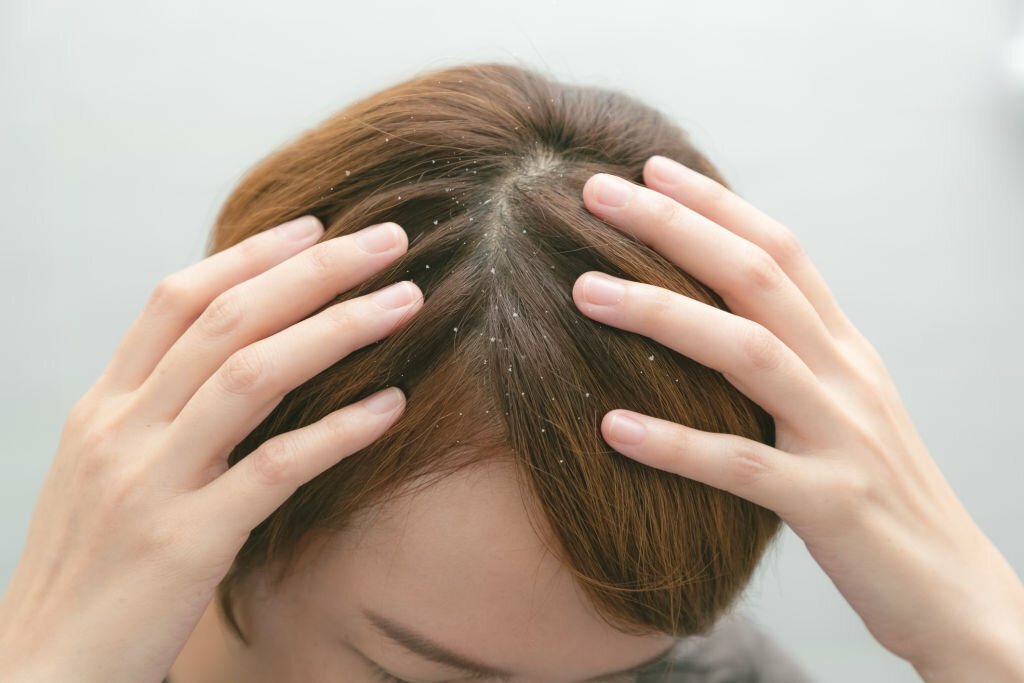 Hair Care Routine To Get Rid Of Hair Dandruff [A Simple Guide]